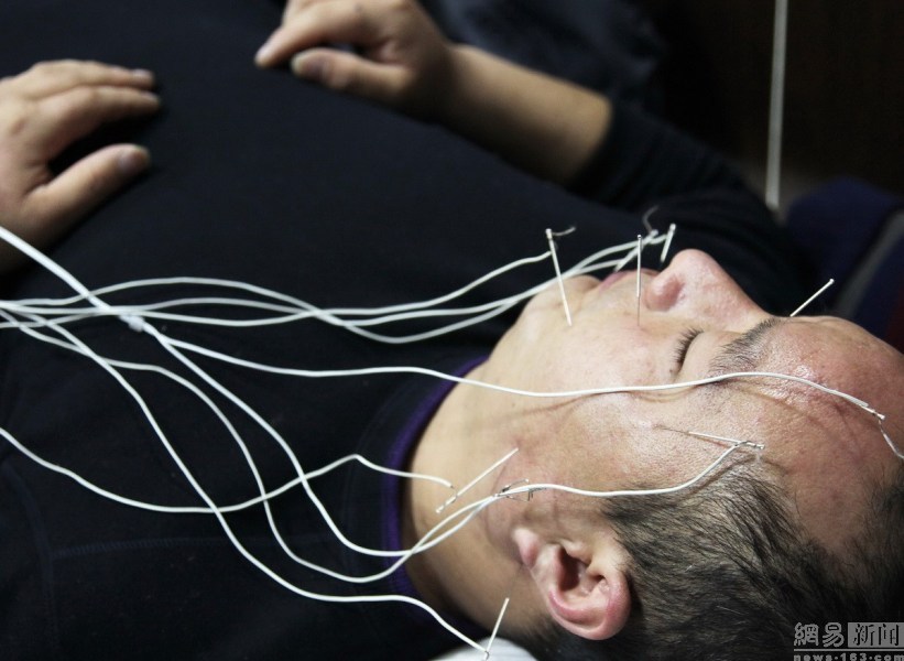 2012年02月21日,陕西咸阳,一位面瘫患者正在接受面部针灸加电疗辅助