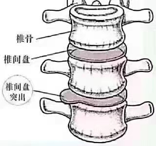 这就是腰椎间盘突出!