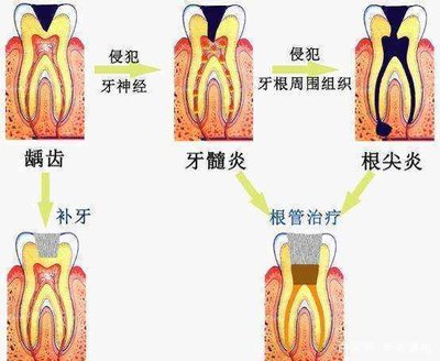 科普课堂|牙髓炎知多少